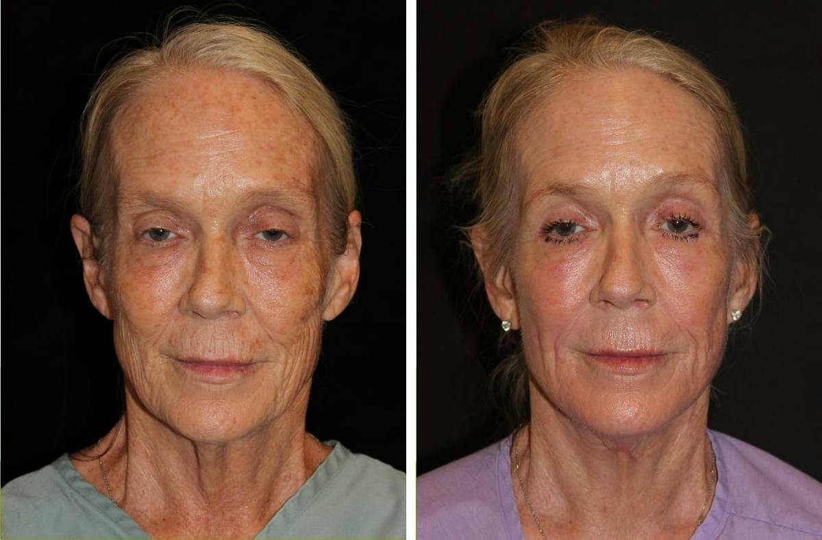 Facelift Before & After Gallery - Patient 221445 - Image 1