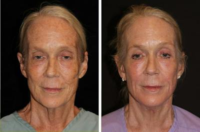 Facelift Before & After Gallery - Patient 221445 - Image 1