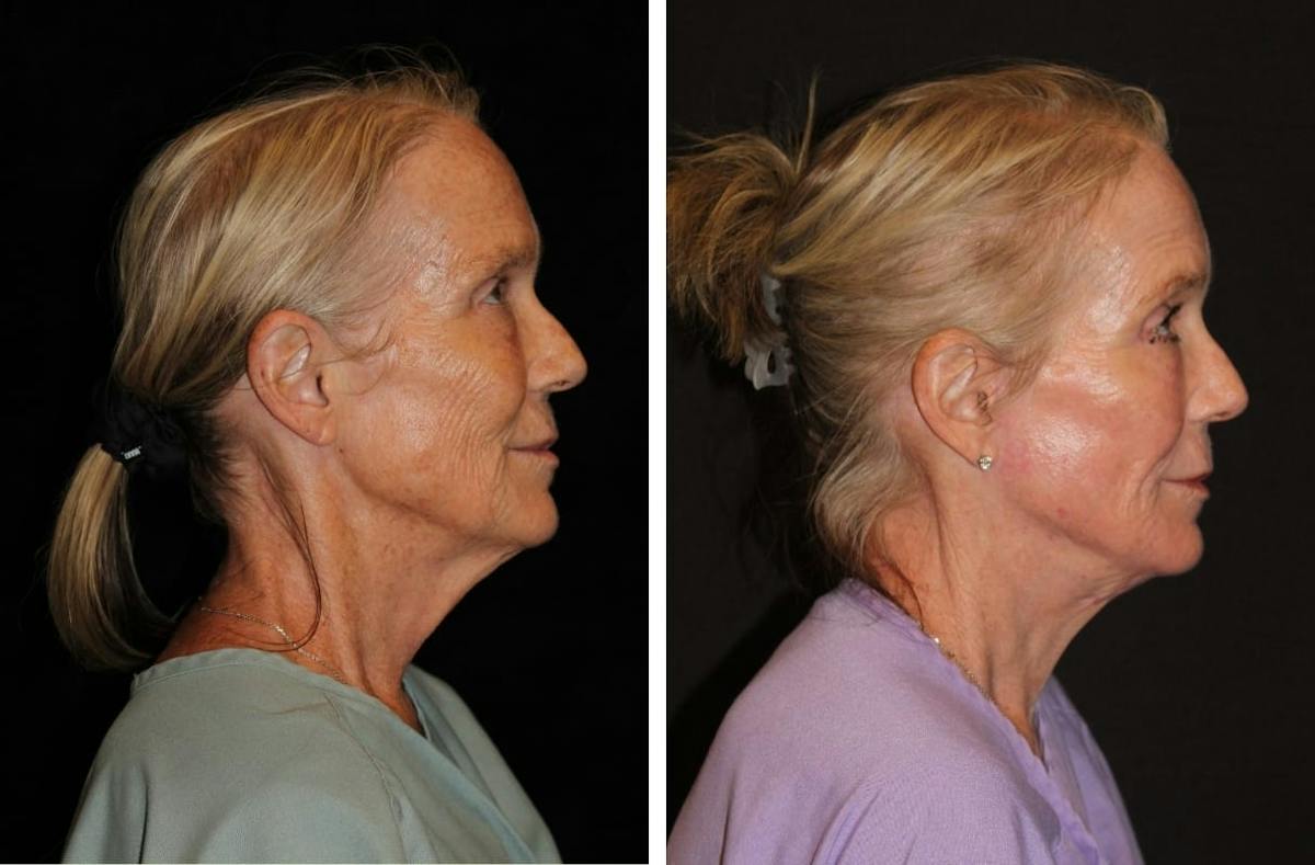 Facelift Before & After Gallery - Patient 221445 - Image 3