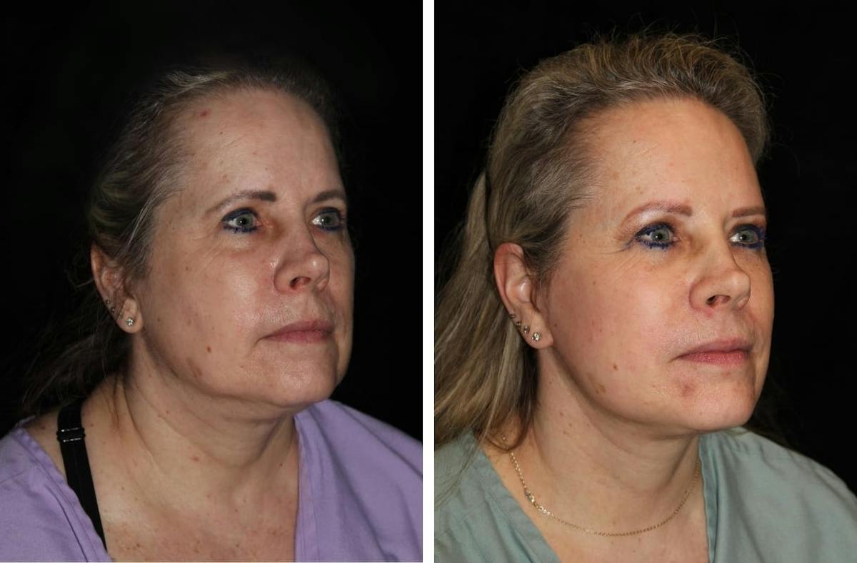 Facelift Before & After Gallery - Patient 931144 - Image 2