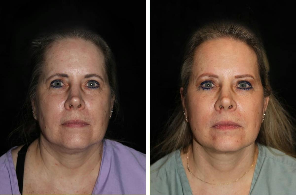 Facelift Before & After Gallery - Patient 931144 - Image 1