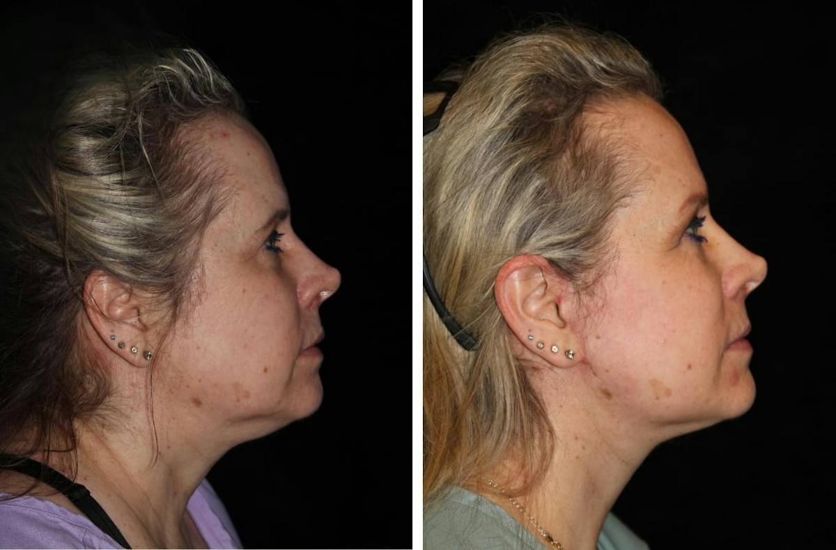 Facelift Before & After Gallery - Patient 931144 - Image 3
