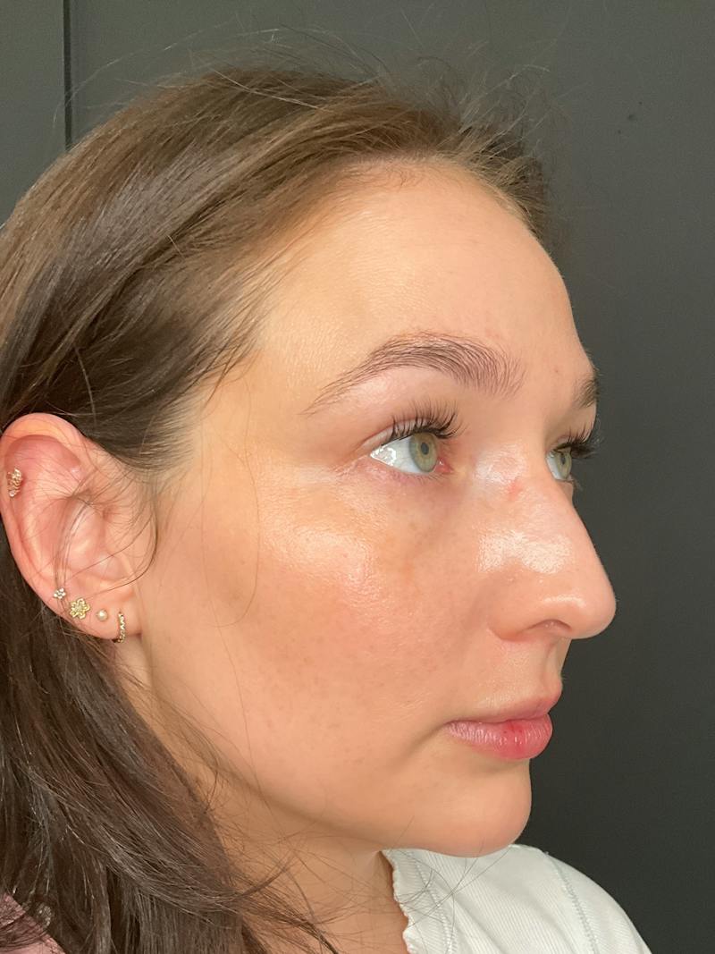SAFElipo Before & After Gallery - Patient 334860 - Image 2