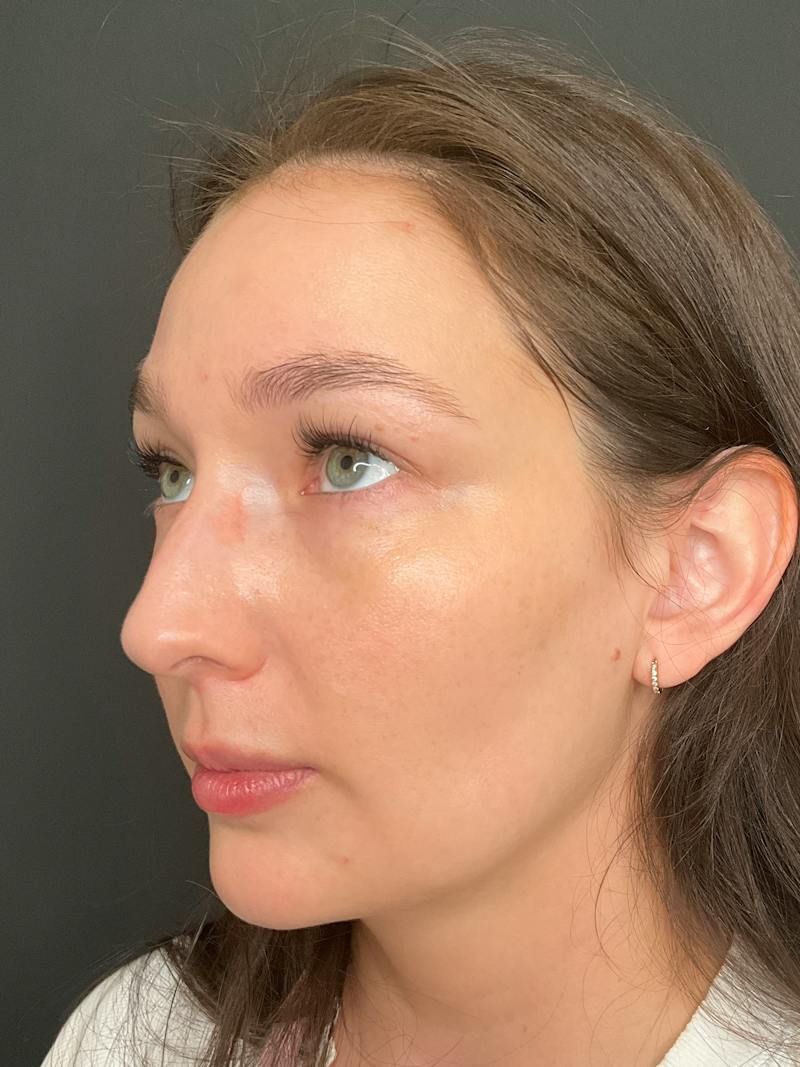 SAFElipo Before & After Gallery - Patient 334860 - Image 6