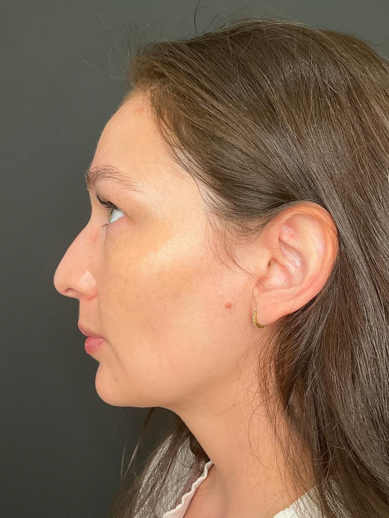 SAFElipo Before & After Gallery - Patient 334860 - Image 8