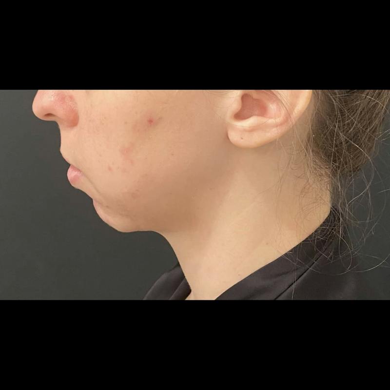 Chin Enhancement Before & After Gallery - Patient 205037 - Image 1