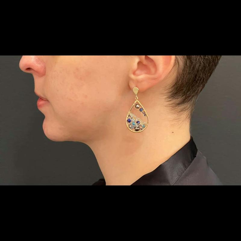Chin Enhancement Before & After Gallery - Patient 205037 - Image 2