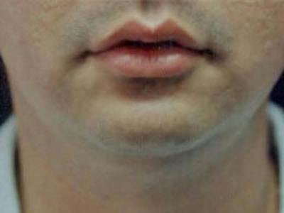 Chin Enhancement Before & After Gallery - Patient 418509 - Image 1