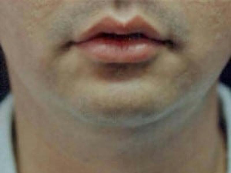 Chin Enhancement Before & After Gallery - Patient 418509 - Image 1