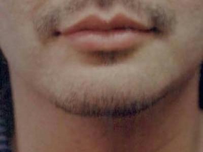 Chin Enhancement Before & After Gallery - Patient 418509 - Image 2