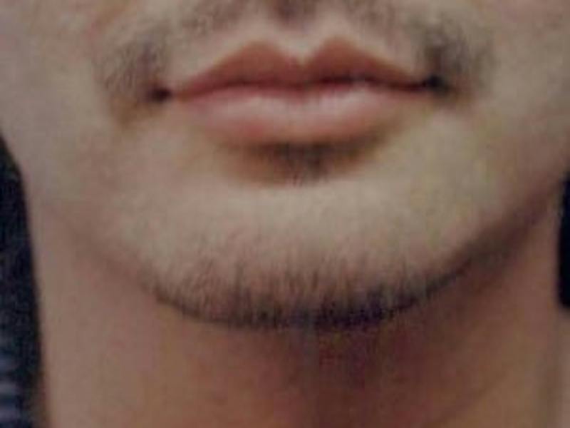 Chin Enhancement Before & After Gallery - Patient 418509 - Image 2