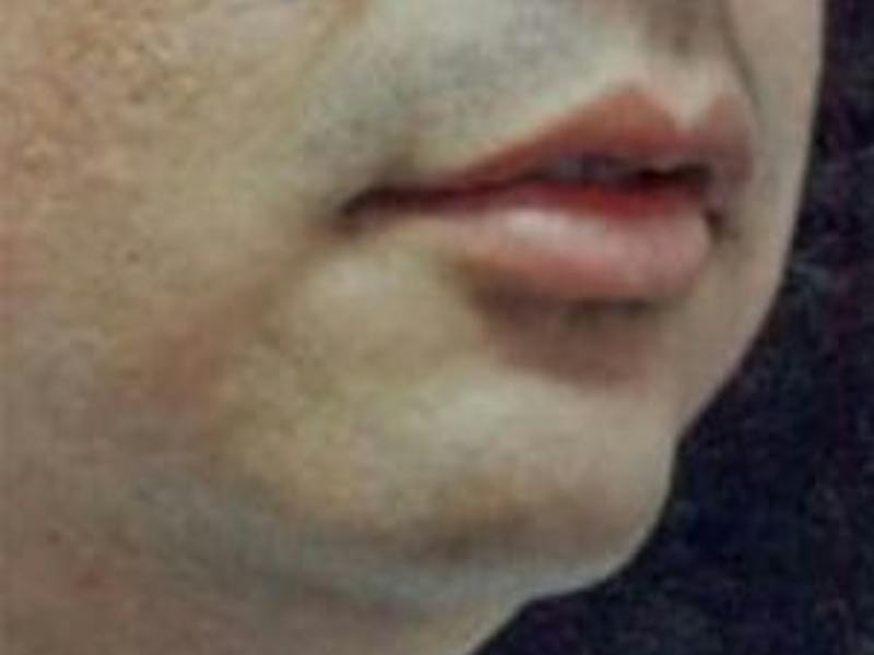 Chin Enhancement Before & After Gallery - Patient 418509 - Image 3