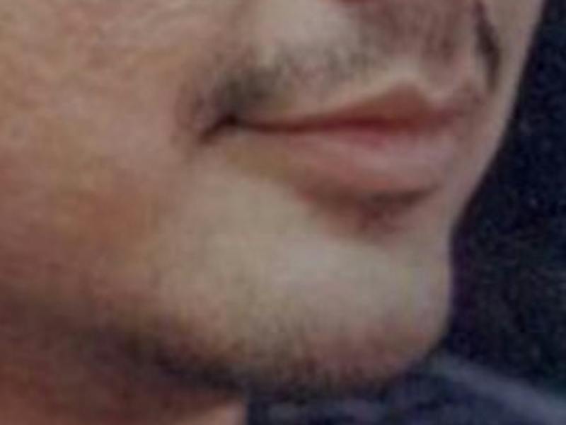 Chin Enhancement Before & After Gallery - Patient 418509 - Image 4
