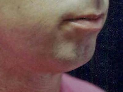 Chin Enhancement Before & After Gallery - Patient 192379 - Image 1