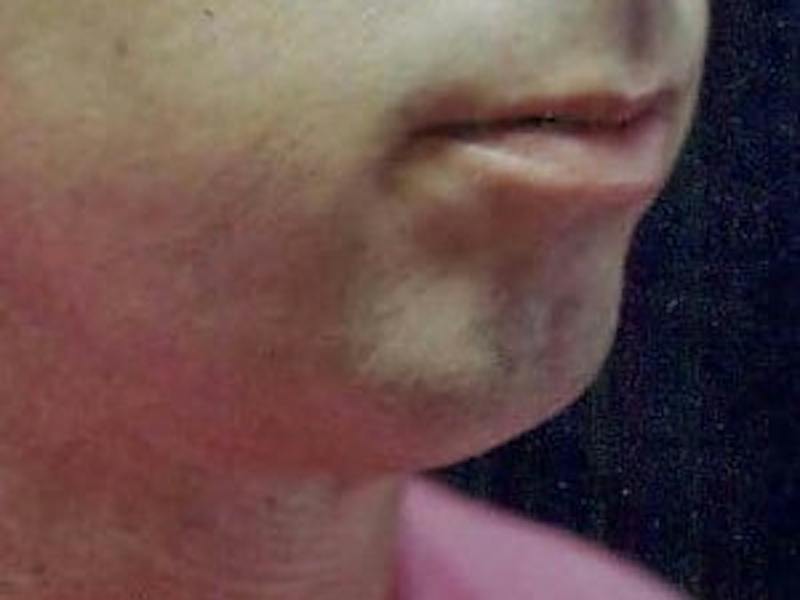 Chin Enhancement Before & After Gallery - Patient 192379 - Image 1