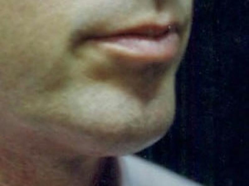 Chin Enhancement Before & After Gallery - Patient 192379 - Image 2
