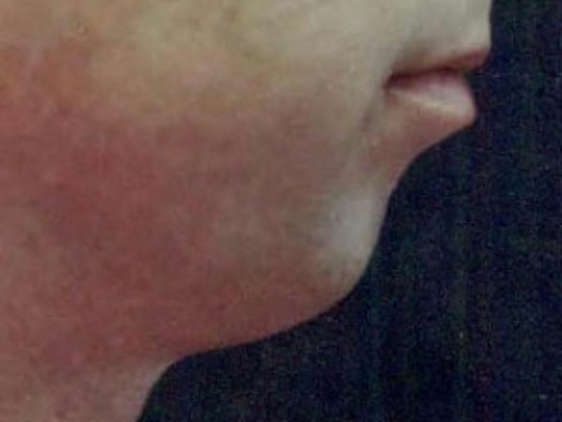 Chin Enhancement Before & After Gallery - Patient 192379 - Image 3