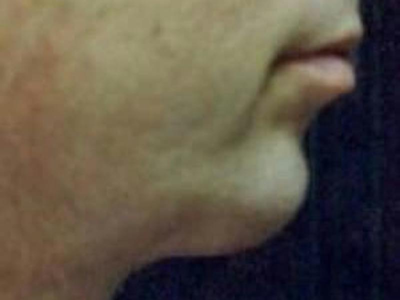 Chin Enhancement Before & After Gallery - Patient 192379 - Image 4