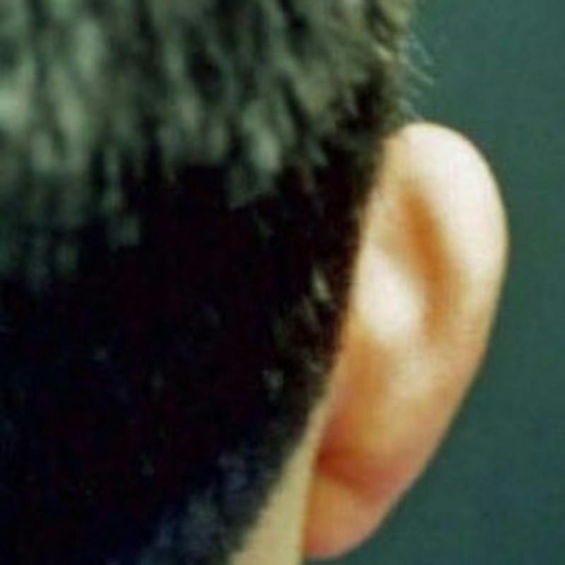 Ear Reshaping Before & After Gallery - Patient 186392 - Image 1