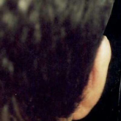 Ear Reshaping Before & After Gallery - Patient 186392 - Image 2