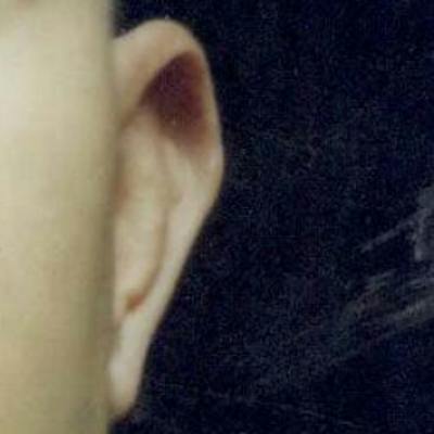 Ear Reshaping Before & After Gallery - Patient 262272 - Image 1