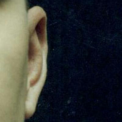 Ear Reshaping Before & After Gallery - Patient 262272 - Image 2