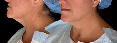 Face + Necklift Before & After Gallery - Patient 749273 - Image 1