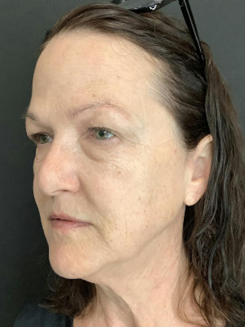 Upper + Lower Blepharoplasty Before & After Gallery - Patient 258718 - Image 1