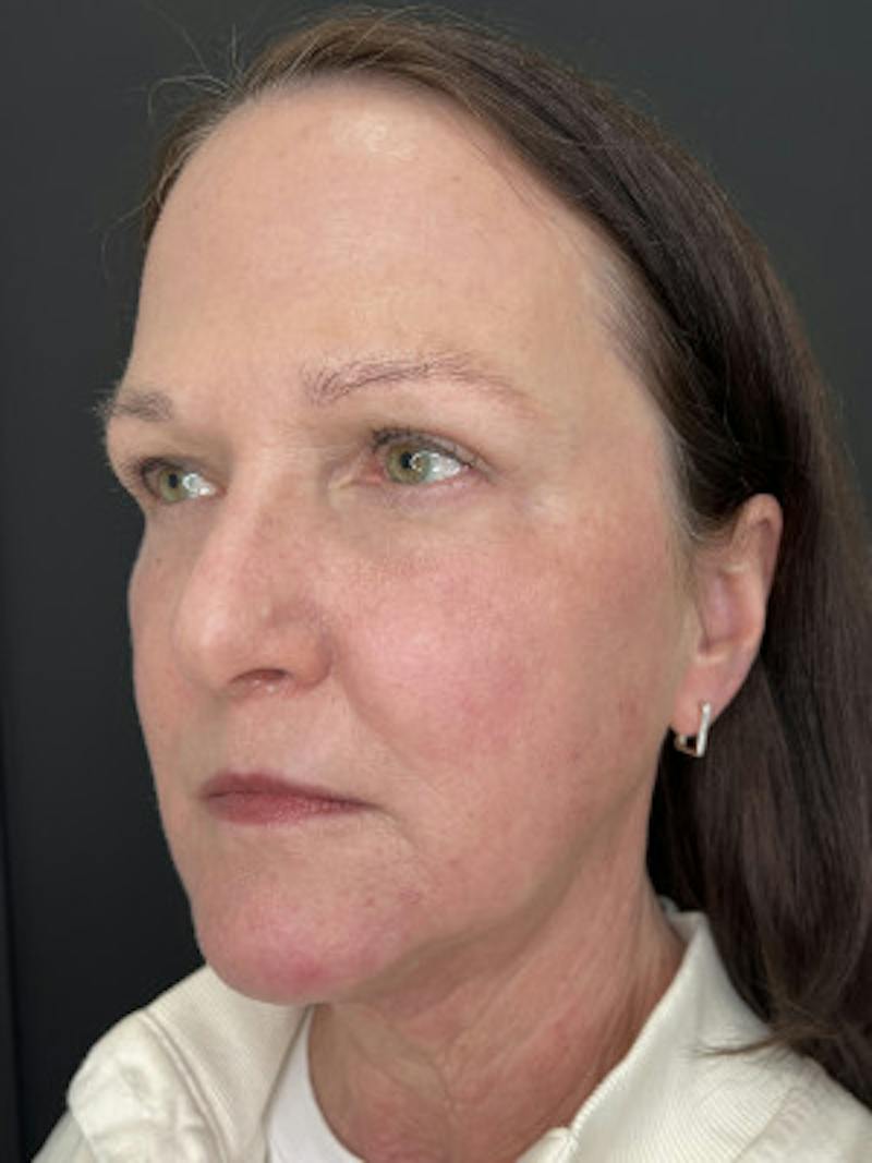 Upper + Lower Blepharoplasty Before & After Gallery - Patient 258718 - Image 2