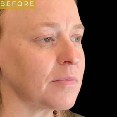 Facial Fat Transfer Before & After Gallery - Patient 241911 - Image 1