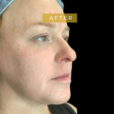 Facial Fat Transfer Before & After Gallery - Patient 241911 - Image 2
