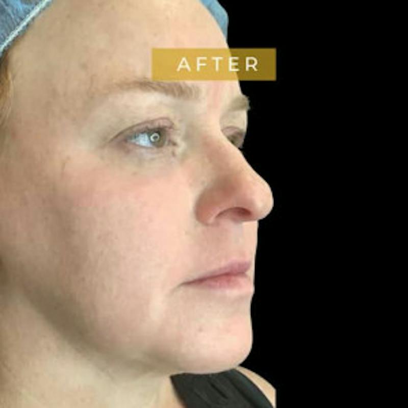 Facial Fat Transfer Before & After Gallery - Patient 241911 - Image 2