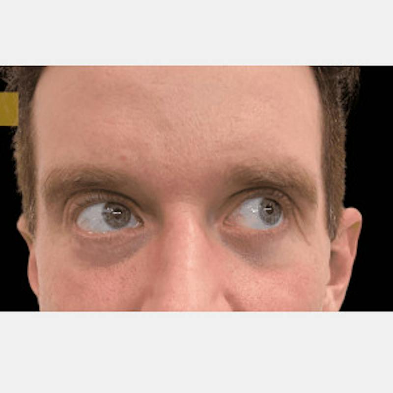 Facial Fat Transfer Before & After Gallery - Patient 371974 - Image 1