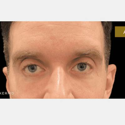 Facial Fat Transfer Before & After Gallery - Patient 371974 - Image 2