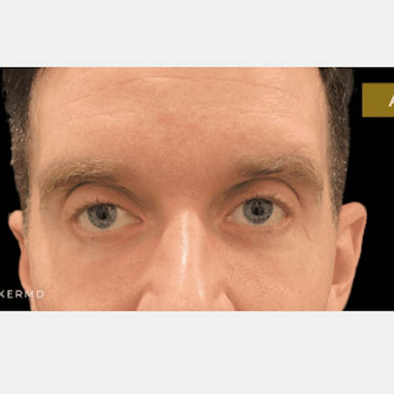 Facial Fat Transfer Before & After Gallery - Patient 371974 - Image 2