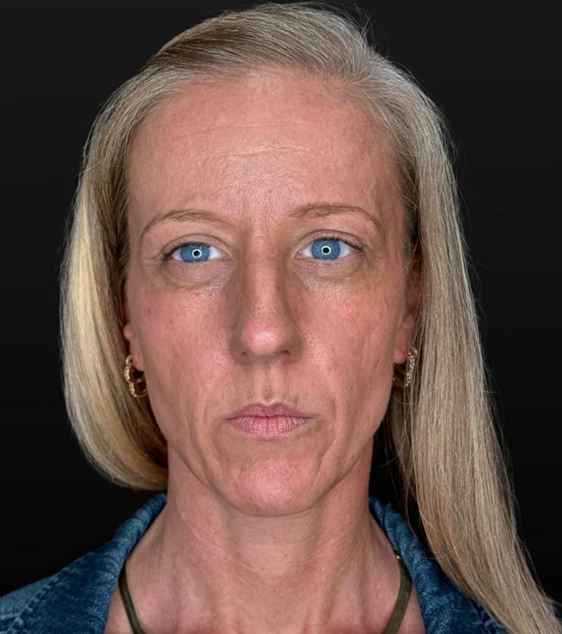 Filler Before & After Gallery - Patient 181200 - Image 1