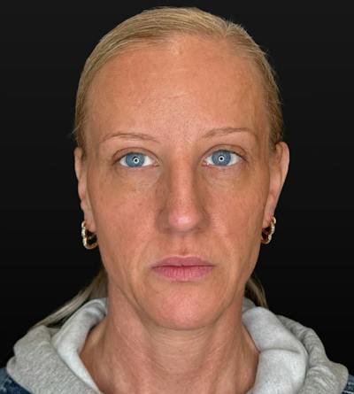 BOTOX Before & After Gallery - Patient 220547 - Image 2