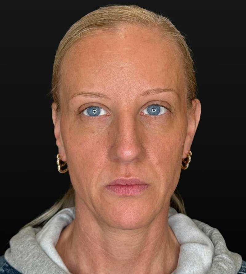 Filler Before & After Gallery - Patient 181200 - Image 2