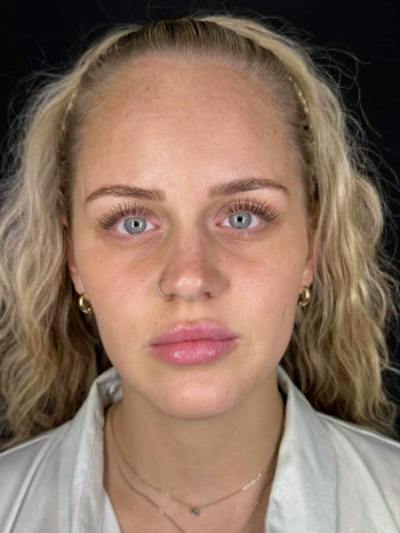 Filler Before & After Gallery - Patient 270166 - Image 1