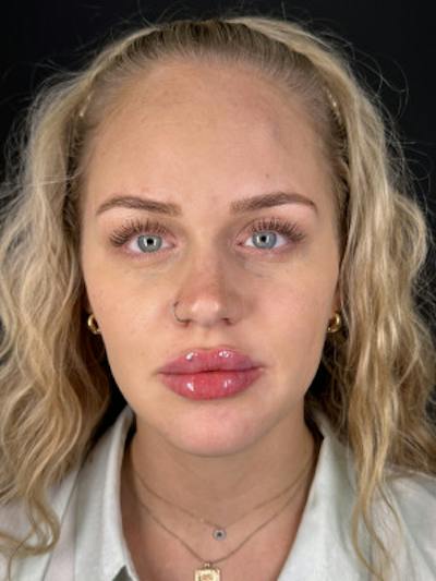 Filler Before & After Gallery - Patient 270166 - Image 2
