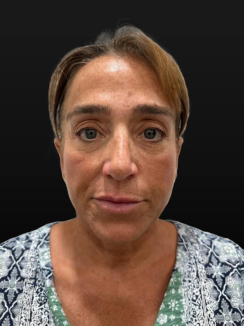 Upper + Lower Blepharoplasty Before & After Gallery - Patient 155341 - Image 1
