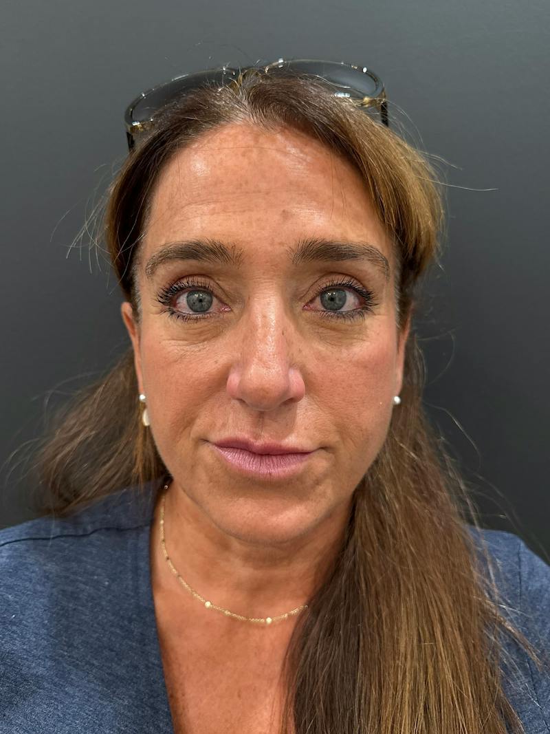Upper + Lower Blepharoplasty Before & After Gallery - Patient 155341 - Image 2