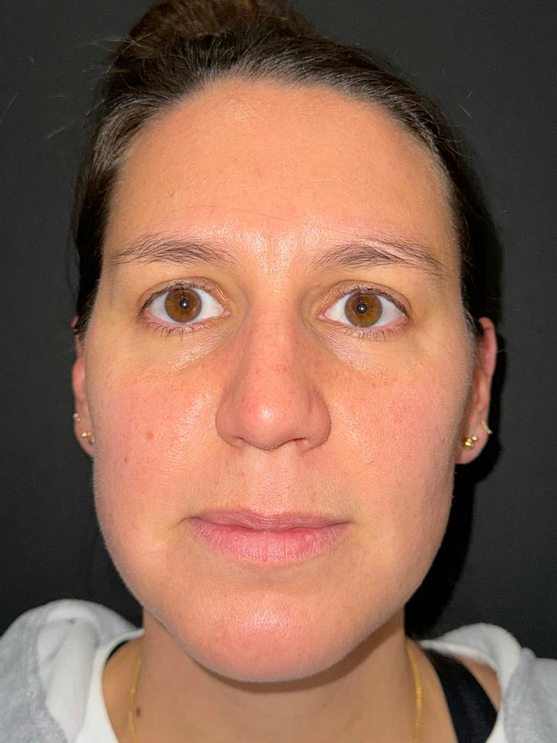 Upper + Lower Blepharoplasty Before & After Gallery - Patient 146439 - Image 1
