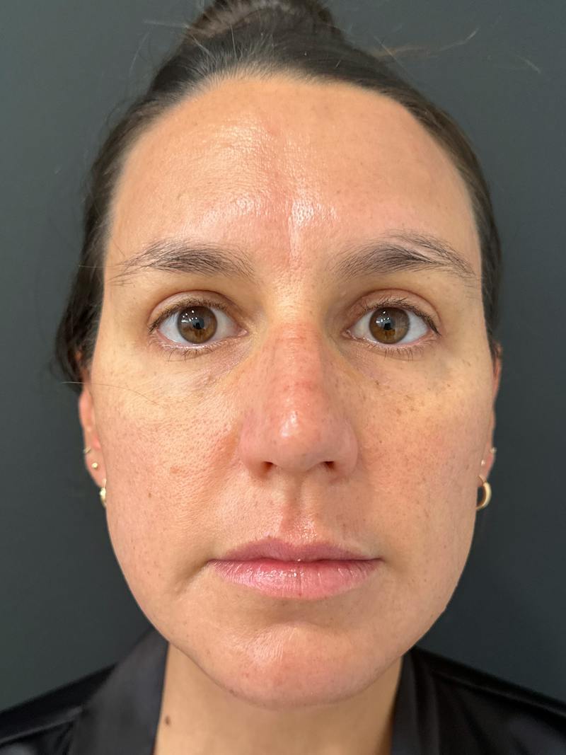 Upper + Lower Blepharoplasty Before & After Gallery - Patient 146439 - Image 2