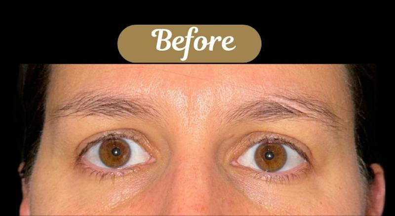 Upper + Lower Blepharoplasty Before & After Gallery - Patient 146439 - Image 3