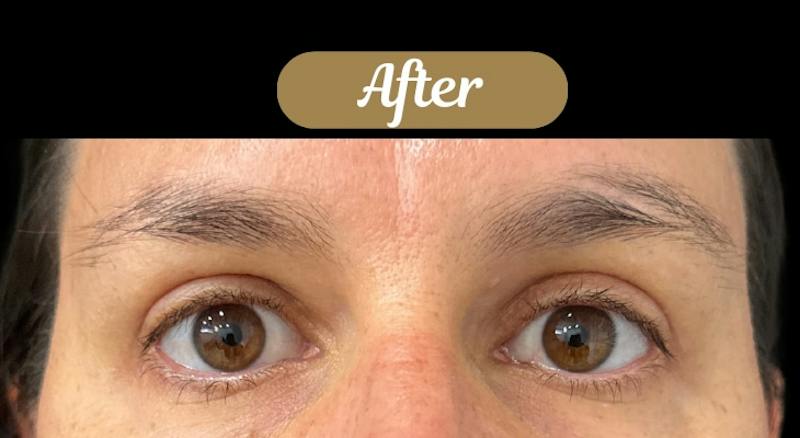Upper + Lower Blepharoplasty Before & After Gallery - Patient 146439 - Image 4