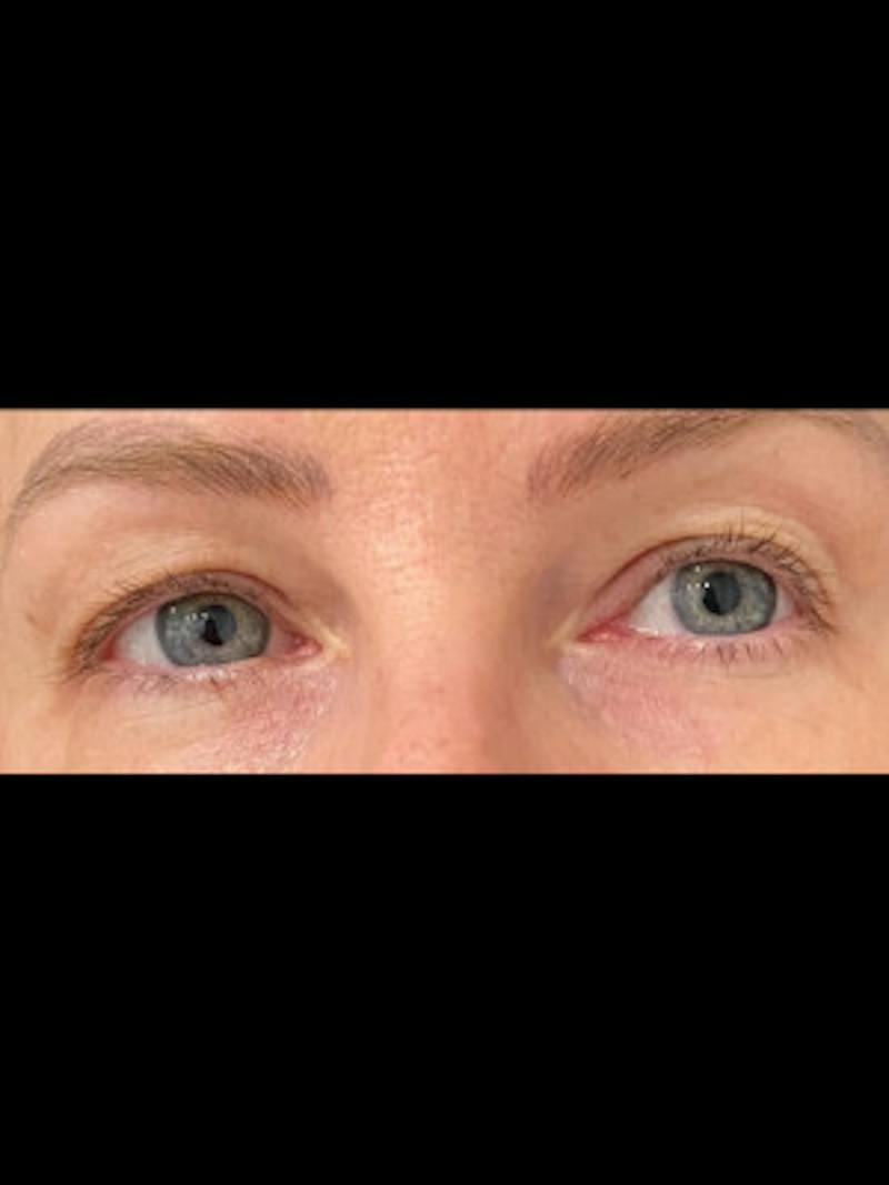 Upper + Lower Blepharoplasty Before & After Gallery - Patient 140779 - Image 1