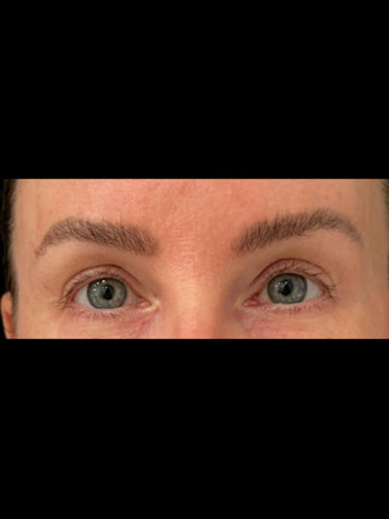 Upper + Lower Blepharoplasty Before & After Gallery - Patient 140779 - Image 2