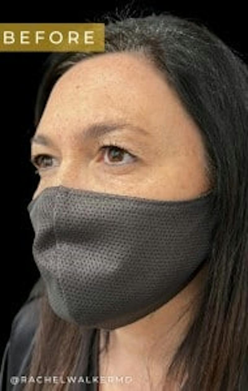 Upper + Lower Blepharoplasty Before & After Gallery - Patient 970249 - Image 1