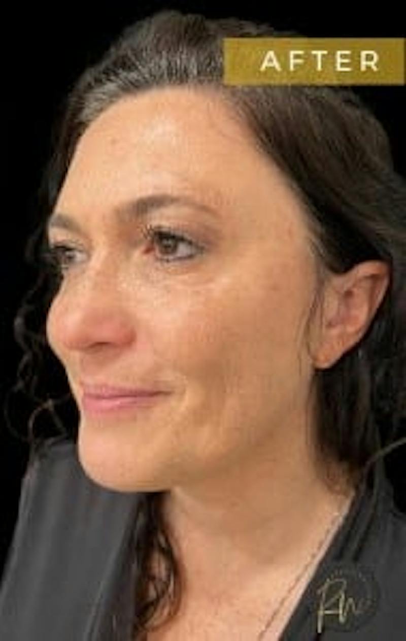Upper + Lower Blepharoplasty Before & After Gallery - Patient 970249 - Image 2